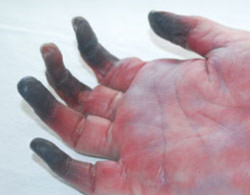 Hoại tử 5 ngón tay sau tiêm kháng sinh