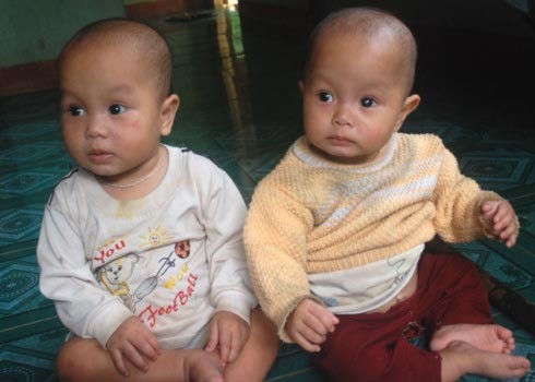Đôi mắt của hai bé song sinh Phạm Thị Bích Phi và Phạm Thị Bích Nhung đang mờ dần, có nguy cơ phải bỏ mắt vì ung thư võng mạc. Ảnh: Trí Tín