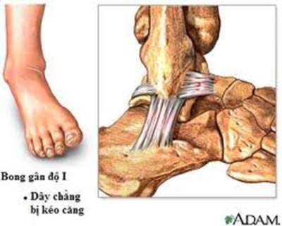 Bong gân và cách xử trí