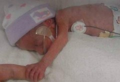 Em bé kỳ diệu ở Ấn Độ nặng 495g khi sinh