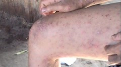 Hàng trăm người tại Quảng Ngãi bị ngứa là do ghẻ ruồi