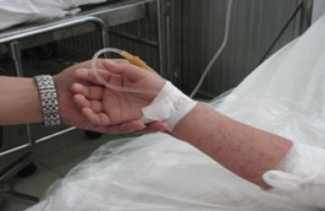 Dịch bệnh tay chân miệng bùng phát với virus độc tính cao