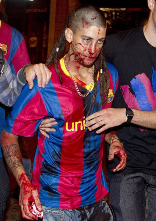 Fan Barca đổ máu vì ăn mừng quá khích