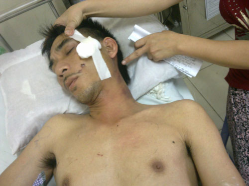 Những vết dẫm đạp lên vơ thể anh Trung còn in rõ vết giầy, dép.