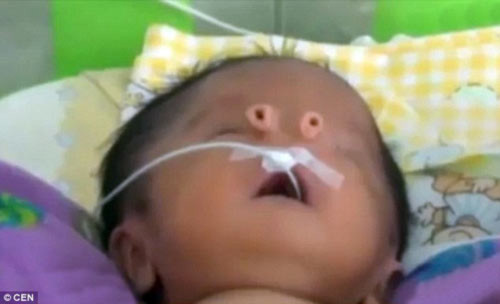 Bệnh hiếm gặp: Em bé sinh ra với hai mũi tách biệt - 2