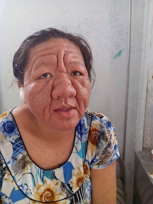 Chị Tha Ra 29 tuổi nhưng có khuôn mặt biến dạng như bà lão 70 tuổi. Ảnh báo Kiến Thức
