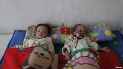 Trẻ em Bắc Triều Tiên bị suy dinh dưỡng trong bệnh viện ở Haeju (ảnh tư liệu).